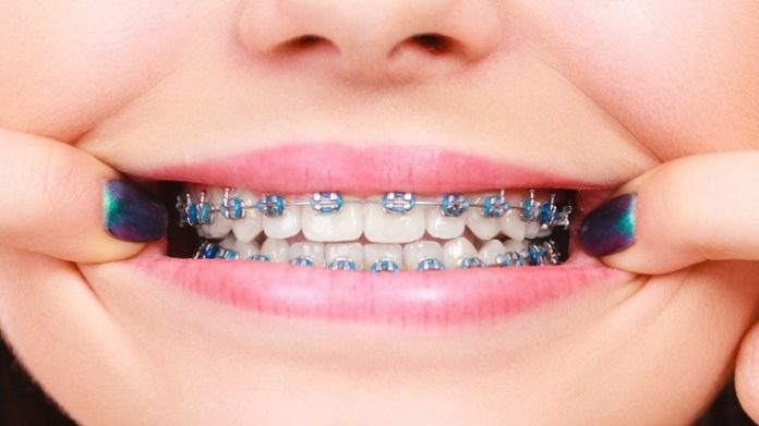 how do dentist put on braces